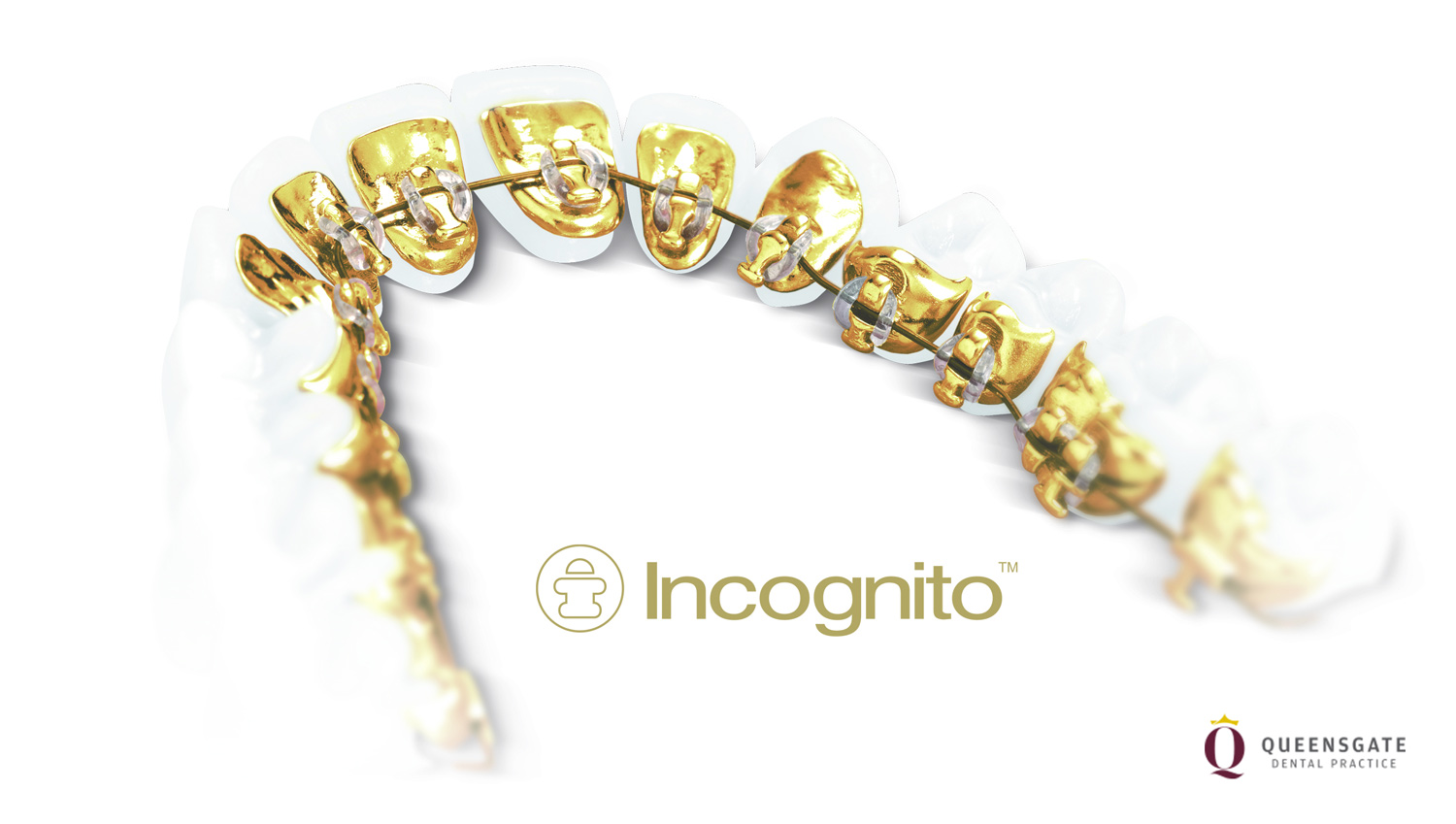 Incognito Braces Queensgate Dental Practice
