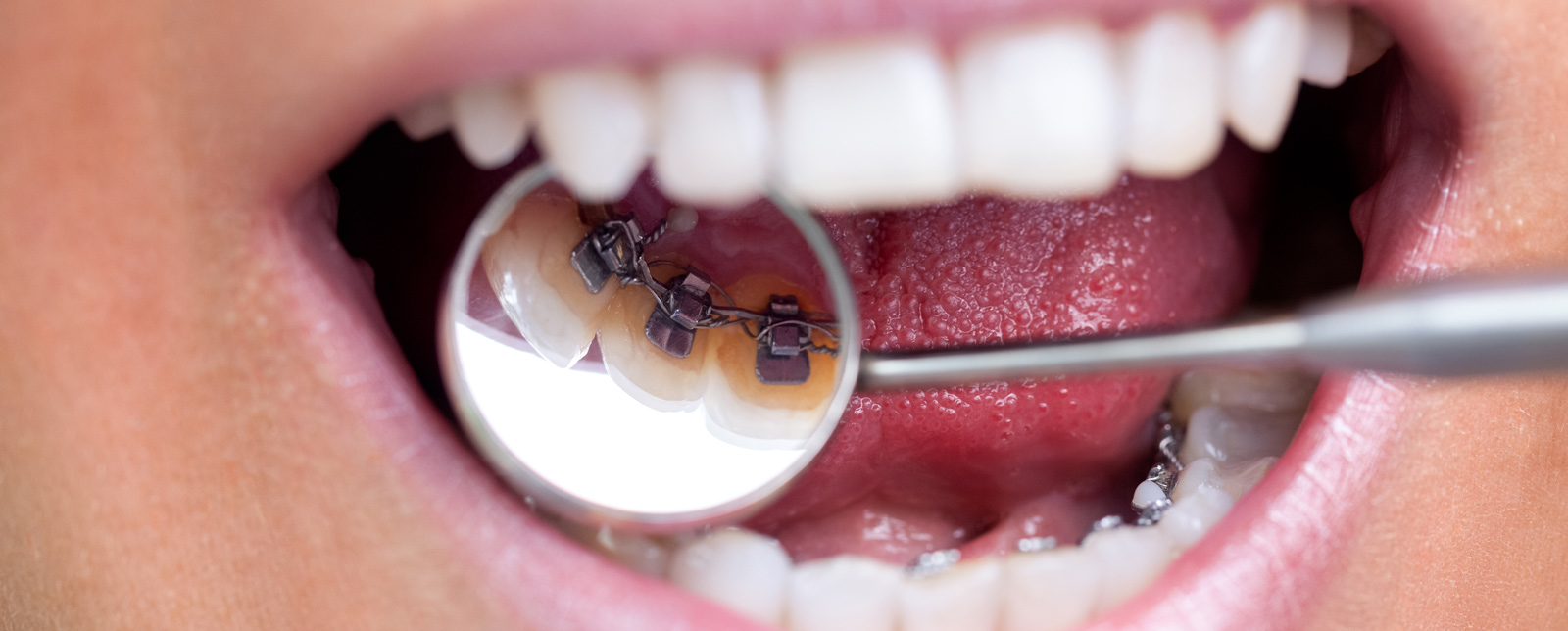 Lingual Braces Queensgate Dental Practice