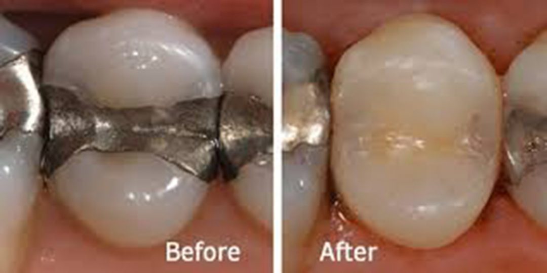 Tooth coloured fillings Queensgate Dental Practice