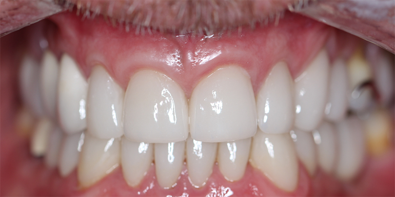 t5after